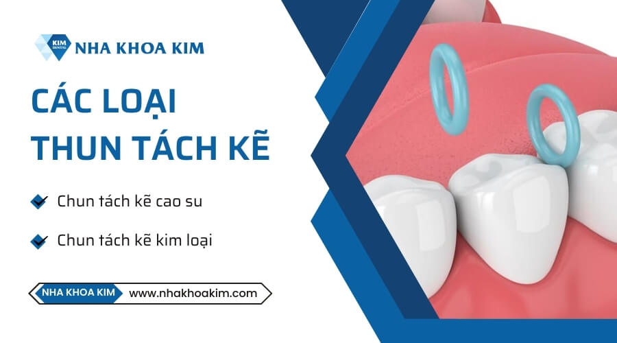 Có mấy loại thun tách kẽ?