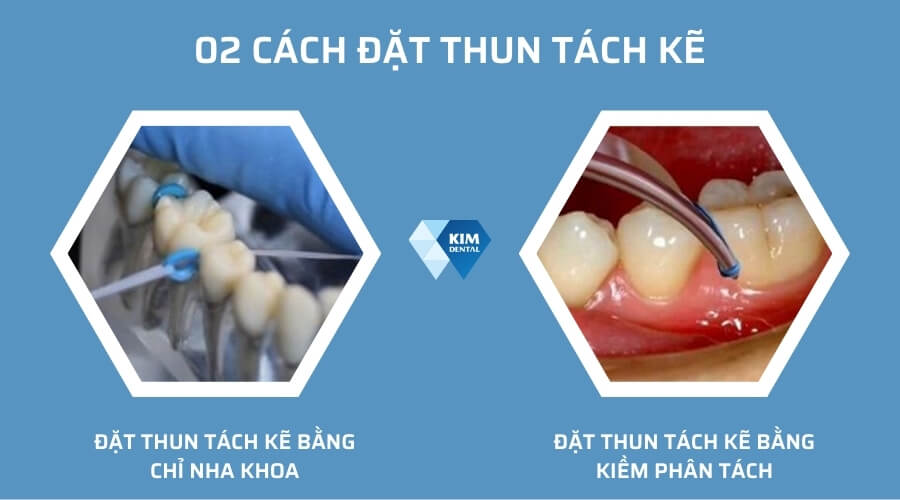 Hướng dẫn cách đặt thun tách kẽ vào răng