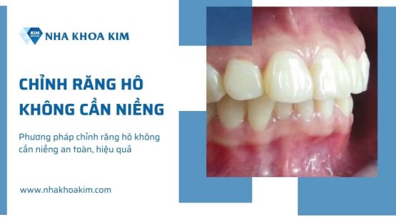 Phương pháp chỉnh răng hô không cần niềng an toàn, hiệu quả