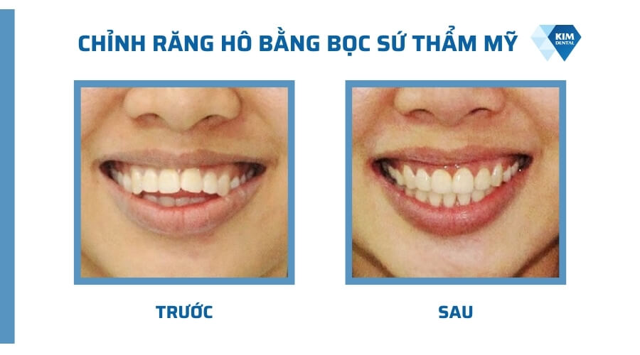 Cải thiện tình trạng răng hô bằng phương pháp bọc sứ