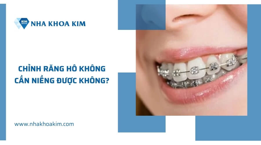 Chỉnh răng hô không cần niềng được không?