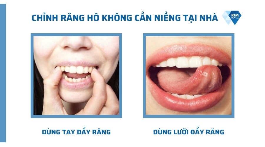 Cách chỉnh răng hô không cần niềng tại nhà