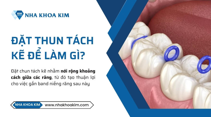 Tác dụng của thun tách kẽ