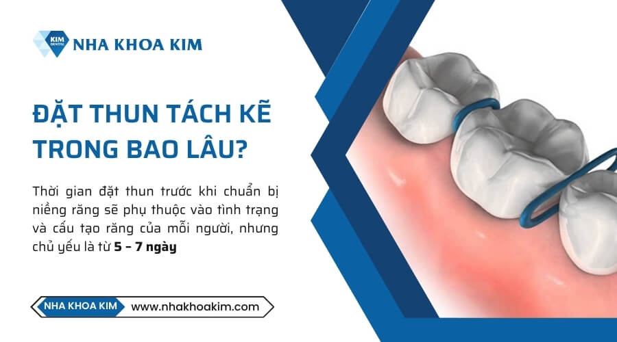 Đặt thun tách kẽ trong bao lâu?