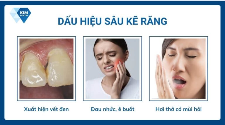 Sâu kẽ răng: Nguyên nhân, dấu hiệu và cách khắc phục