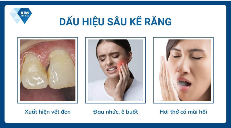 Dấu hiệu nhận biết sâu kẽ răng