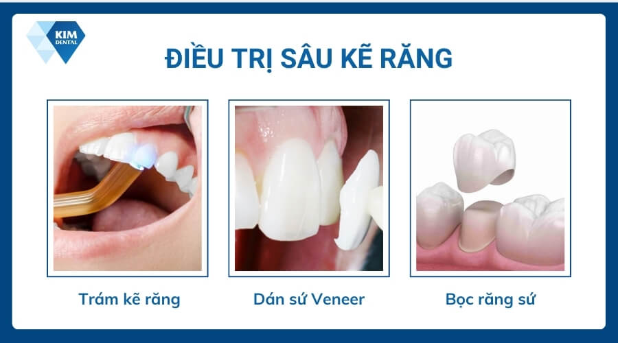 Cách khắc phục sâu kẽ răng hiệu quả