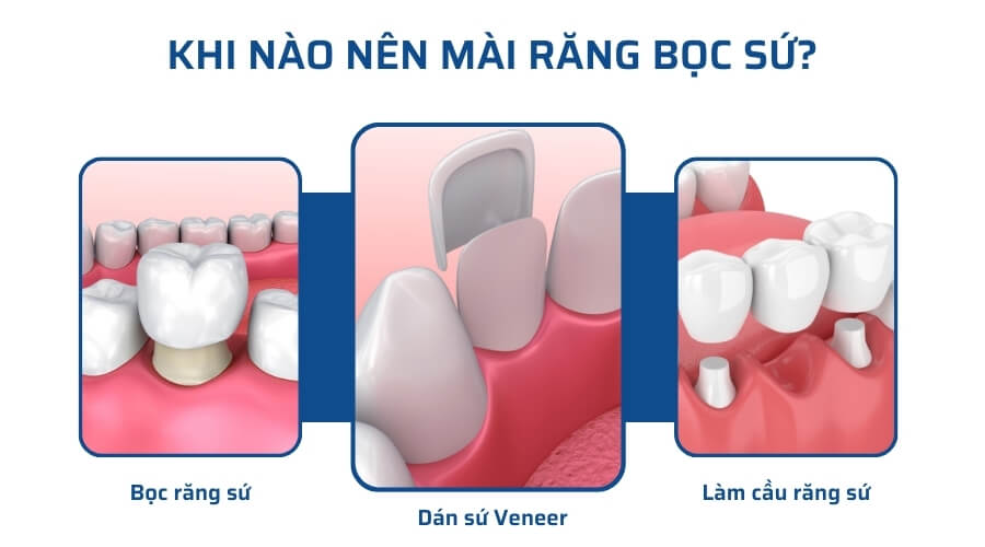 Nên mài răng khi nào?