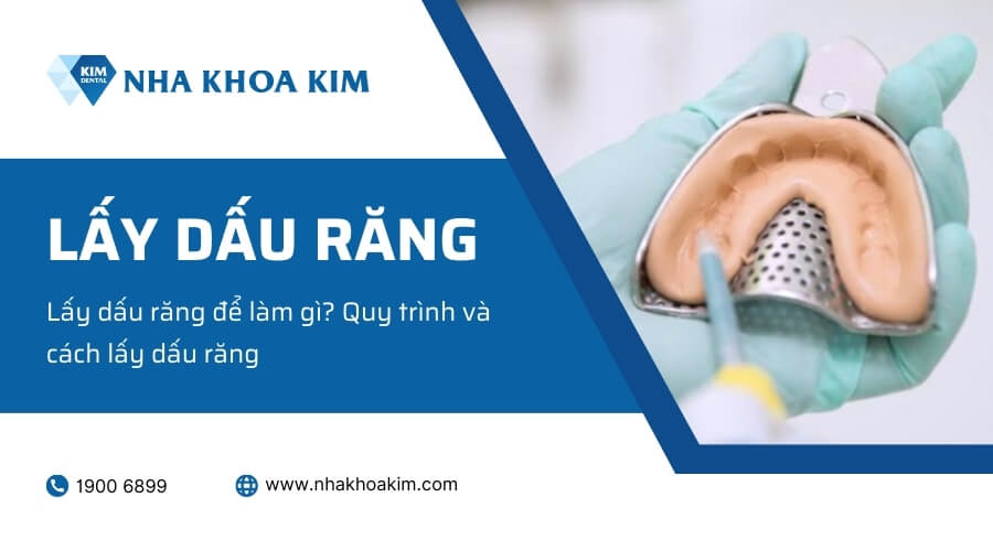 Lấy dấu răng để làm gì? Quy trình và cách lấy dấu răng