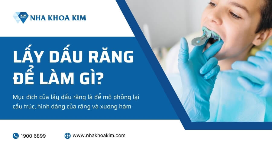 Lấy dấu răng để làm gì?