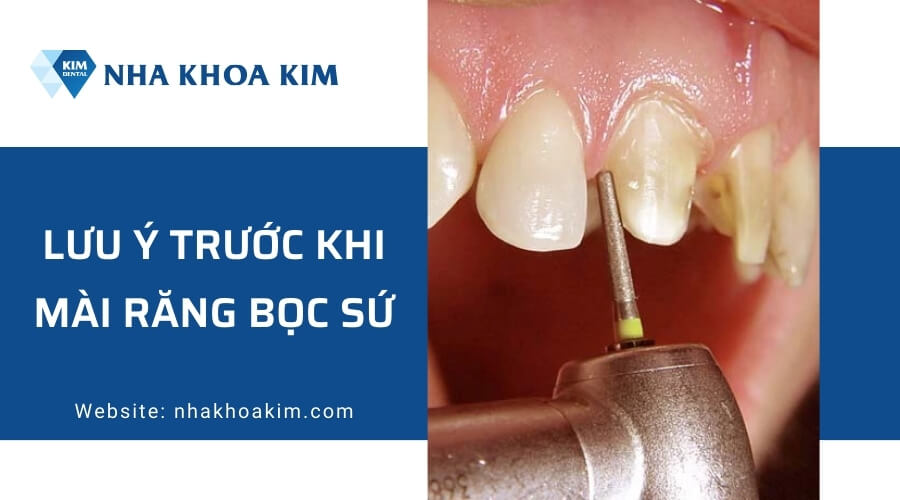 Một số lưu ý trước khi mài răng bọc sứ