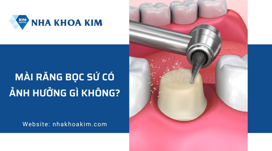 Mài răng bọc sứ có ảnh hưởng gì không?