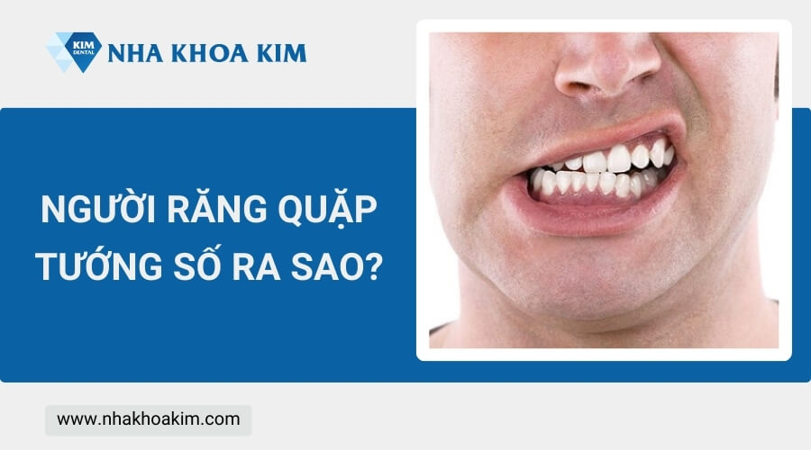 Răng quặp có ý nghĩa gì trong tướng số?