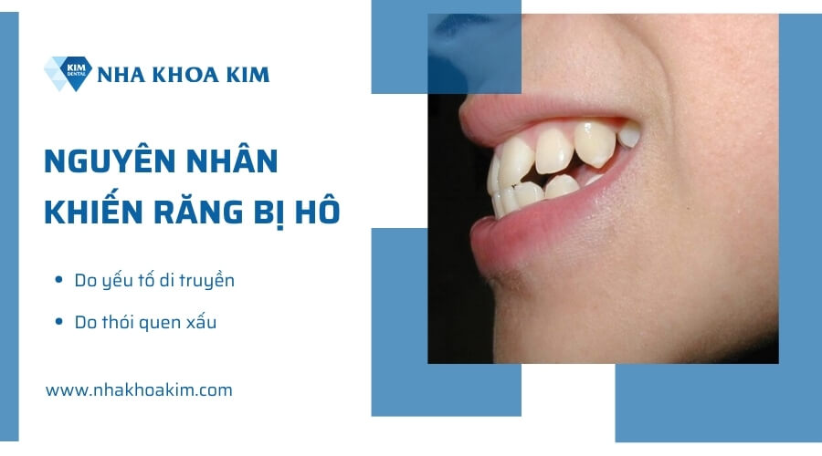 Nguyên nhân khiến răng bị hô