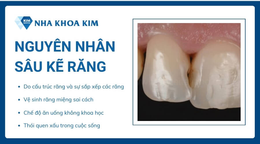 Nguyên nhân gây sâu kẽ răng