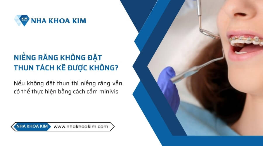 Niềng răng không đặt thun tách kẽ được không?