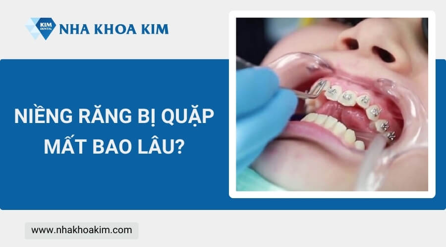 Niềng răng bị quặp mất bao lâu?