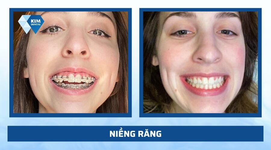 Niềng răng chỉnh khớp cắn chuẩn