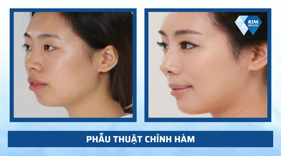 Cách đưa về khớp cắn chuẩn bằng phương pháp phẫu thuật hàm
