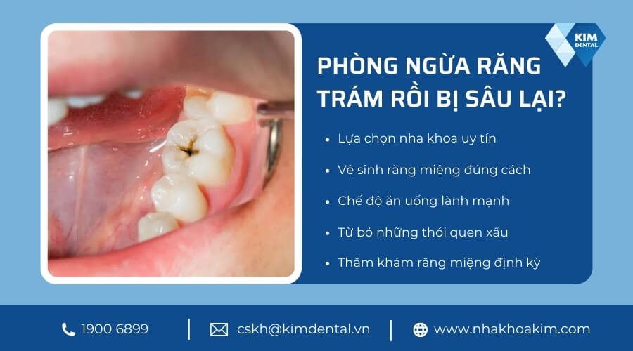 Cách hạn chế tình trạng răng trám rồi bị sâu lại