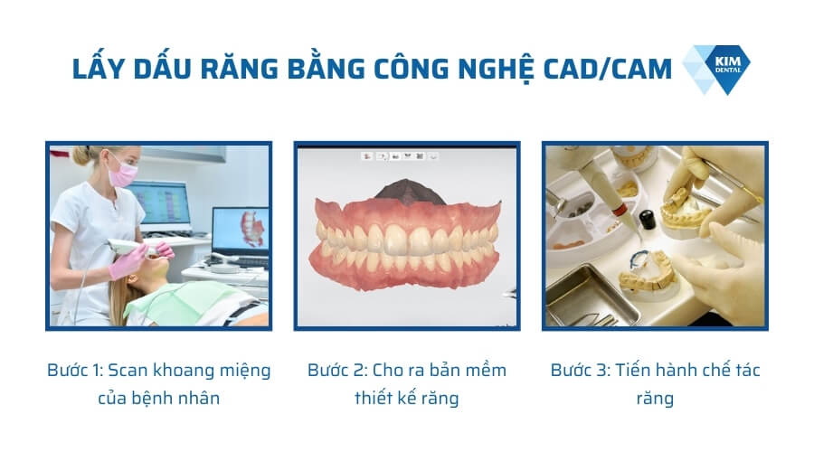 quy trình lấy dấu răng bằng công nghệ CAD/CAM