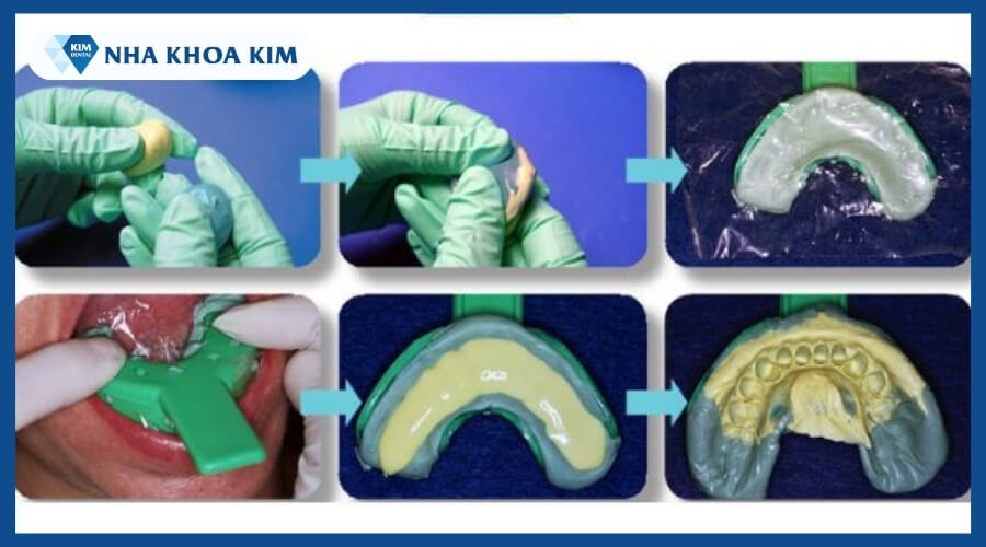 Quy trình lấy dấu răng một thì