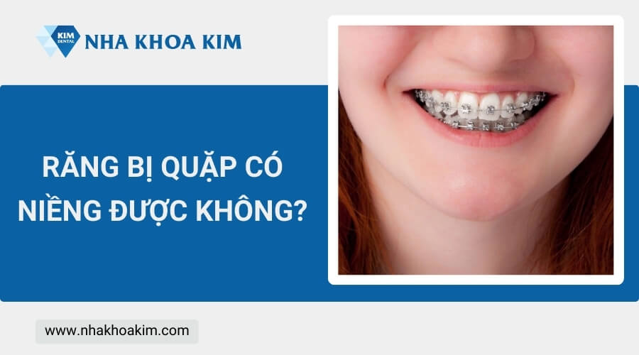 Răng bị quặp có niềng được không?