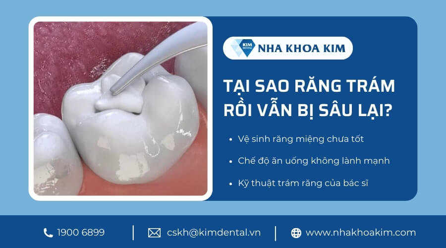 Tại sao răng trám rồi vẫn bị sâu lại?