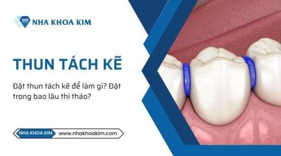 Đặt thun tách kẽ để làm gì? Đặt trong bao lâu thì tháo?