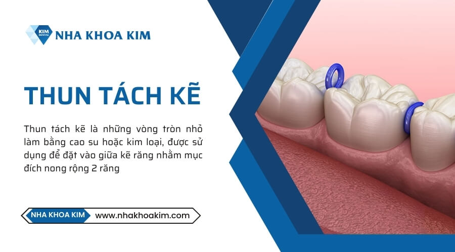 Thun tách kẽ là gì?