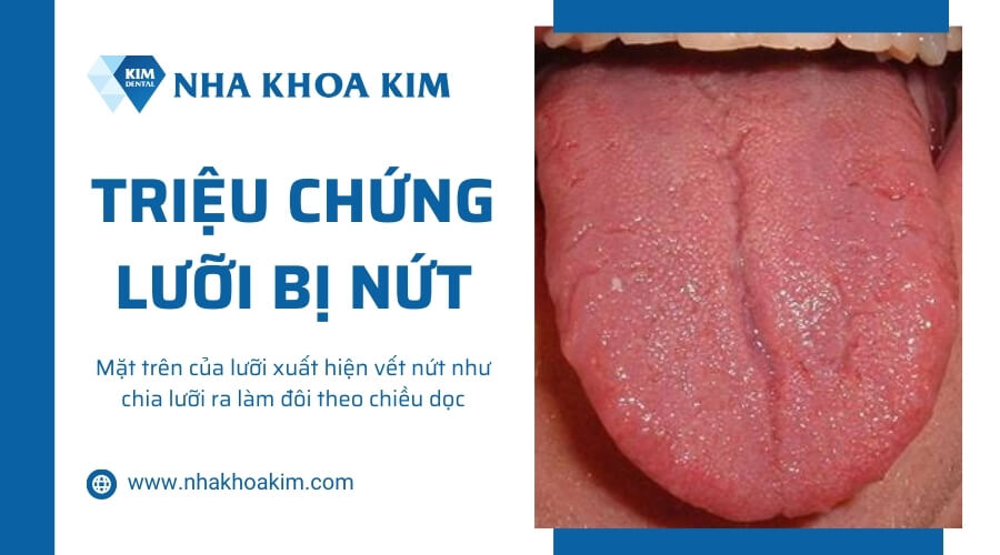 Dấu hiệu lưỡi bị nứt