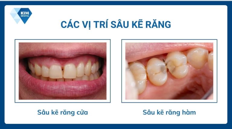 Sâu kẽ răng: Nguyên nhân, dấu hiệu và cách khắc phục