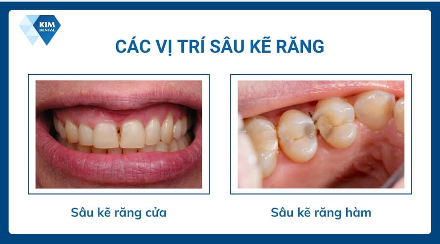 Các vị trí sâu kẽ răng