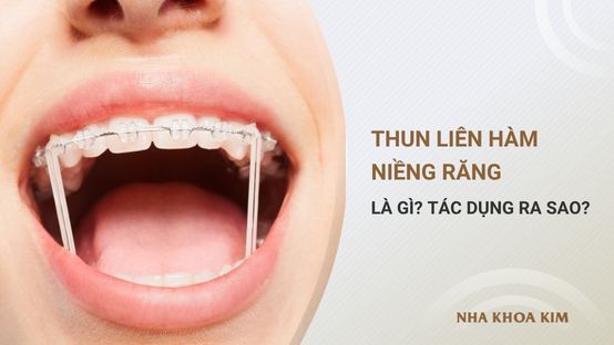 Thun liên hàm là gì? Tác dụng thun liên hàm khi niềng răng