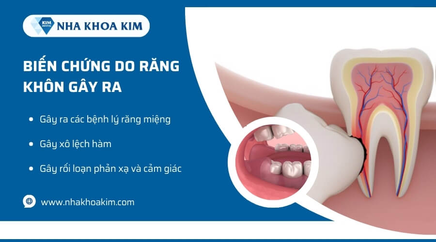 Biến chứng do răng khôn gây ra