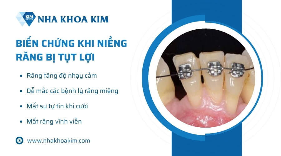Biến chứng khi niềng răng bị tụt lợi