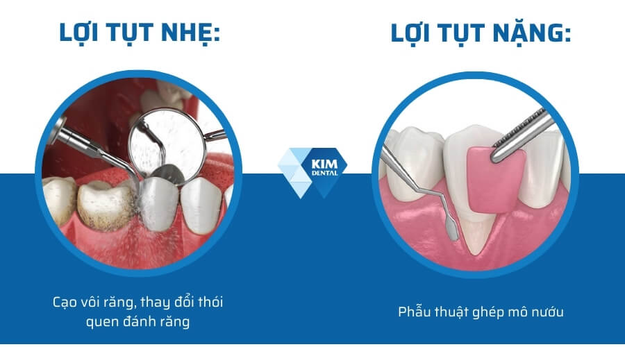 Cách khắc phục tụt lợi khi niềng răng