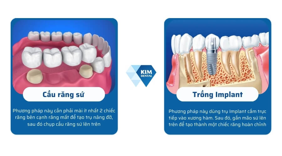 Cầu răng sứ và cấy ghép Implant là gì?