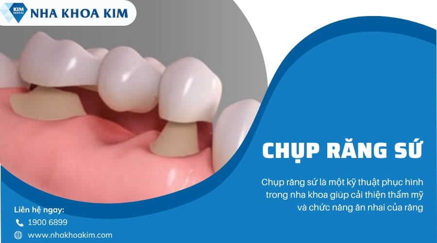 Chụp răng sứ là gì?