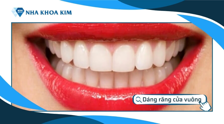 Dáng răng cửa vuông vắn 