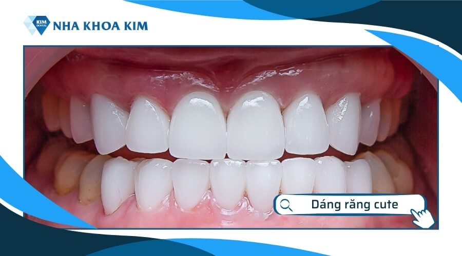 Dáng răng cute