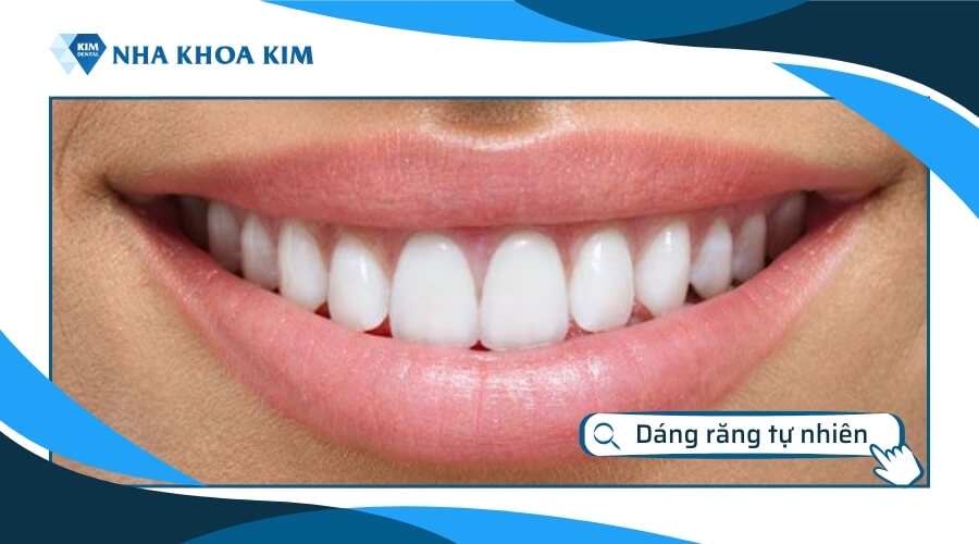 Dáng răng sứ đẹp tự nhiên