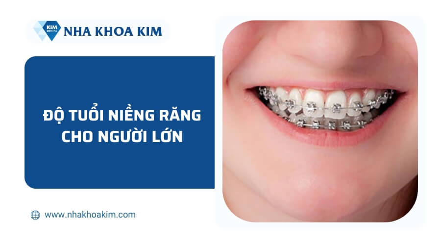 Độ tuổi niềng răng tốt cho người lớn