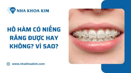Hô hàm có niềng răng được hay không? Vì sao?