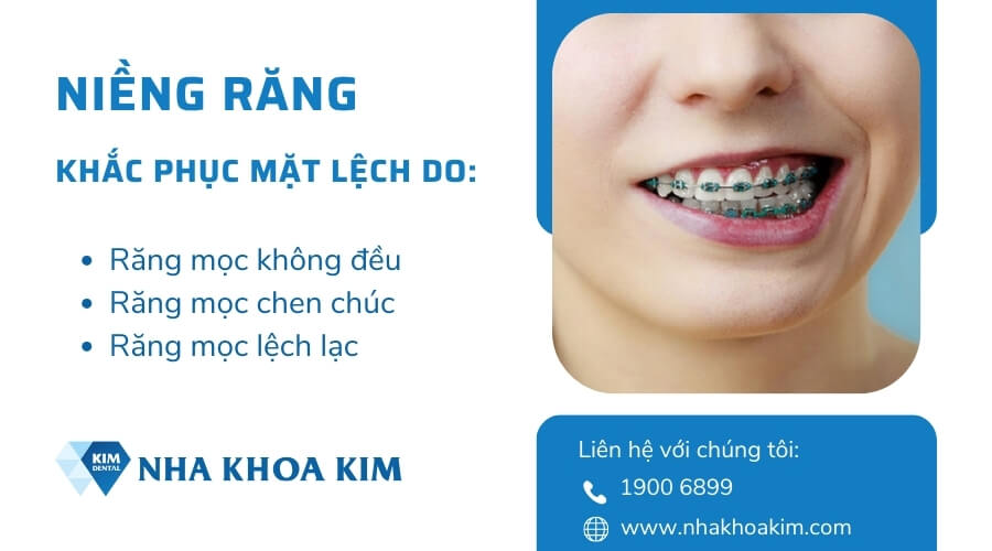 Niềng răng khắc phục tình trạng mặt lệch hiệu quả