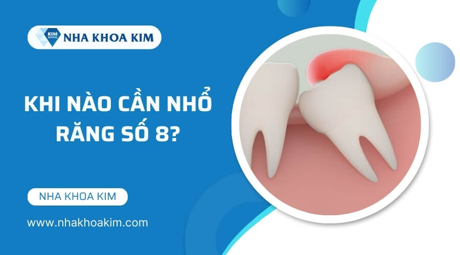 Khi nào cần nhổ răng số 8?