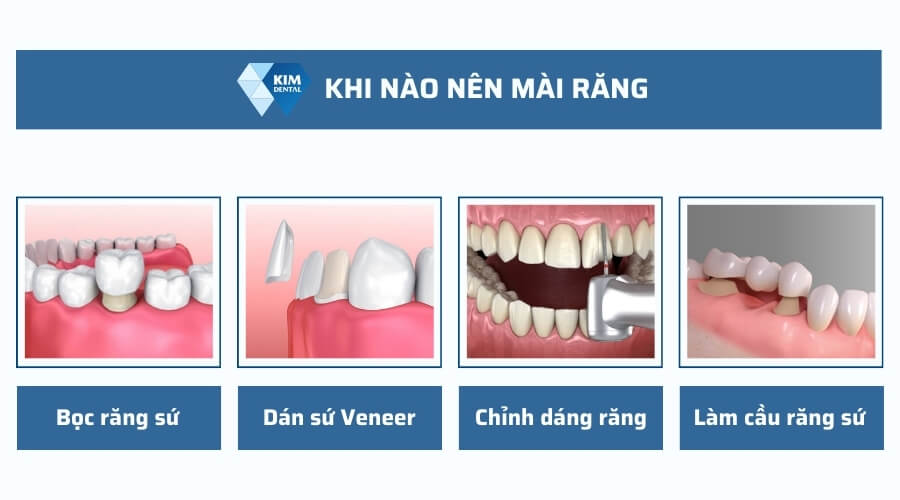 Khi nào nên mài răng