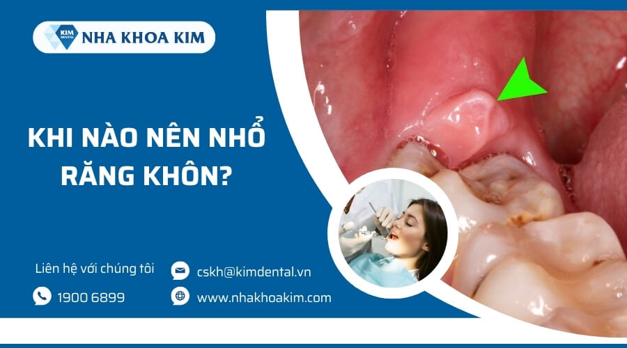 Khi nào nên nhổ răng khôn?