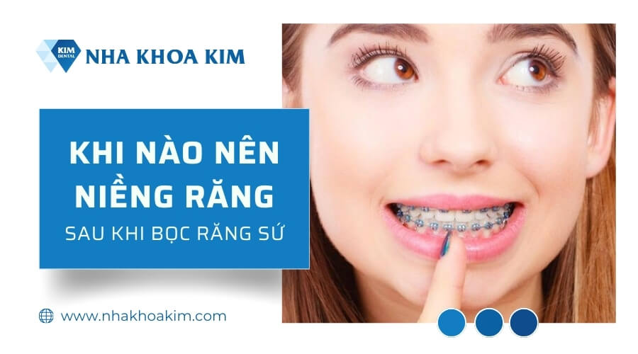 Khi nào nên niềng răng sau khi bọc răng sứ