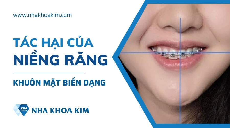 Tác hại của niềng răng sai cách gây biến dạng khuôn măt